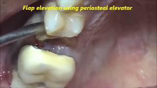 Grossly decayed Upper Pre Molar Extraction [upl. by Mailiw502]