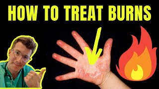 HOW TO TREAT AND MANAGE BURNS AND SCALDS  DOCTOR EXPLAINS plus first aid tips [upl. by Eyllib]