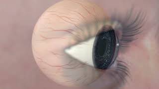 Animation Diabetic Retinopathy [upl. by Meerek]