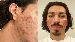 CO2 Laser Treatment for Acne Scars [upl. by Kolivas902]