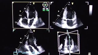 Triplane Echokardiographie triplane echocardiography [upl. by Najtsirk]