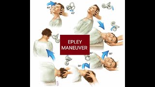 EPLEY MANEUVER  Canalith Repositioning Procedure CRP  Treatment of BPPVHow to do Epley maneuver [upl. by Aimal354]