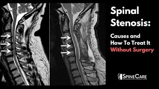 Spinal Stenosis Causes and How to Treat It Without Surgery [upl. by Elmajian]