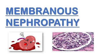 Membranous Nephropathy  Nephrotic Syndrome  Made Easy [upl. by Horbal274]