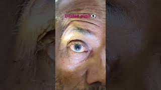 Dilated pupileyespecialist doctor optometry [upl. by Va]