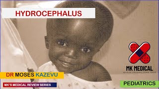 Hydrocephalus [upl. by Nolyarg]