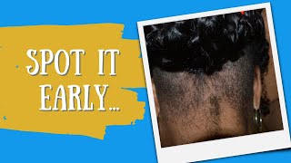 Recognize Neurodermatitis in Your Hair Clients [upl. by Michel]