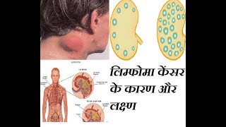 लिम्फोमा केंसर के कारण और लक्ष्ण lymphoma cancer ke kaarn or lakshn [upl. by Tserof]