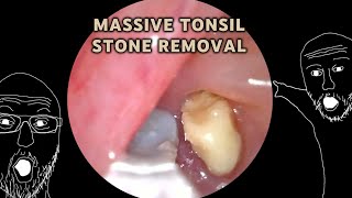 Multitude of Massive Tonsil stones removed  AIM 20 [upl. by Natalee]