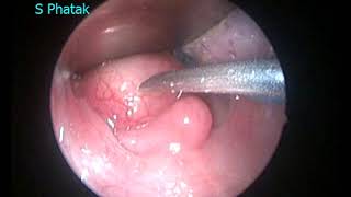 Retropharyngeal Abscess [upl. by Dirraj]