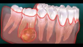 Abcès endodontique dentaire kyste [upl. by Slrahc256]