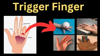 A Complete Guide to Trigger Finger [upl. by Styles]