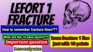 How to remember Lefort 1 fracture lineLEFORT 1 FRACTURE Linejust in 10 points [upl. by Ravel]