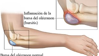 BURSITIS CODO DERRAME ARTICULAR TRATAMIENTO [upl. by Efal]