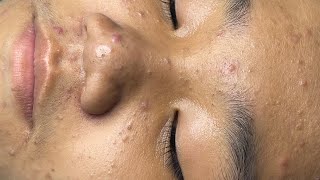 ACNE TREATMENT VU QUYNH MI  Acne Chin amp Nose Of Teen Boy FULL [upl. by Celestine716]