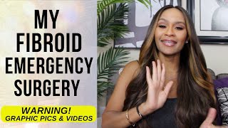 My Fibroid Emergency Surgery with severe Anemia Story  Open Myomectomy GRAPHIC SURGERY CONTENT [upl. by Nyahs]