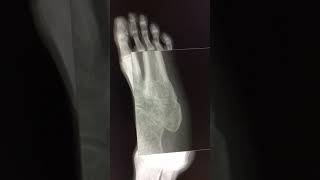 DBTH VFC Mid shaft fracture to the 5th metatarsal [upl. by Whitten]