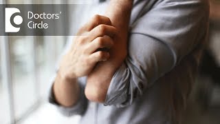 How to manage rashes with severe itching all over the body  Dr Sachith Abraham [upl. by Aela]