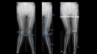 Surgical Realignment Knock Knee Correction [upl. by Einiffit463]