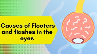 The Untold Cause of Eye Floaters 2024 Are you at risk [upl. by Aveer]