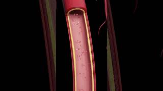 Atherosclerosis The Silent BuildUp [upl. by Dilks]