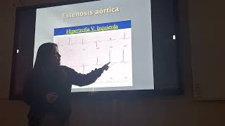 Cardiología  Estenosis aortica e Insuficiencia Aortica [upl. by Butterfield]