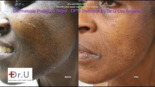 Best Dermatosis Papulosa Nigra Removal in Los Angeles [upl. by Aihcrop147]