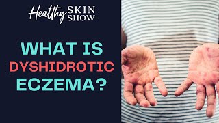 Dyshidrotic Eczema HAND ECZEMA How It Changed My Life Forever  Jennifer Fugo [upl. by Kalle]