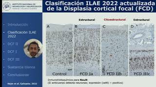 8 Neuropatología de las Displasias corticales Dr Jesús Cienfuegos Meza [upl. by Gauntlett2]