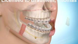 Oberkiefer Vorverlagerung und Unterkiefer Rückverlagerung [upl. by Nosaj402]