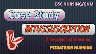 Case study on Intussusception  case study format for pediatric [upl. by Flemings]