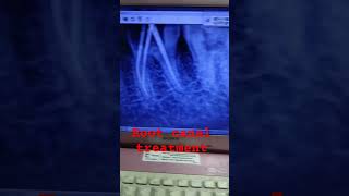 Root canal treatment for grossly carious painful tooth to relieve pain rootcanal dentaltreatment [upl. by Stover]