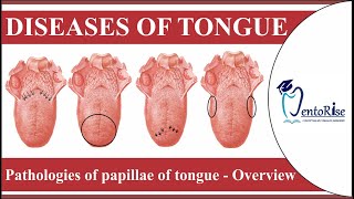 Diseases of tongue  Pathologies of papillae of tongue  Overview  Tongue diseases  Oral Pathology [upl. by Akoyn]