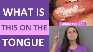 White Fur on Tongue Nurse Reacts shorts  Oral Hairy Leukoplakia [upl. by Naillil]