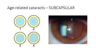 Classification of cataract [upl. by Yenahpets680]