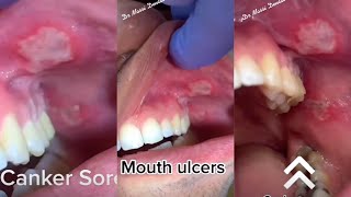 Canker sores [upl. by Kissiah]