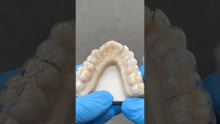 Double Premolar Essix Appliance EnvisiontecMain envisiontec lsk121shorts dentist [upl. by Brigid]