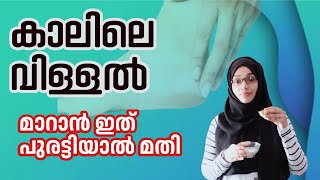 കാലിലെ വിള്ളൽ മാറാൻ ഇത് പുരട്ടിയാൽ മതി  Cracked Heel Home remedy malayalam crackedheelsremedy [upl. by Harris]