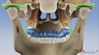 wwwfroehlitherapeuticsch  medizinische Schienentherapie Korrektur Knirscher amp Aufbissschiene [upl. by Ramunni]