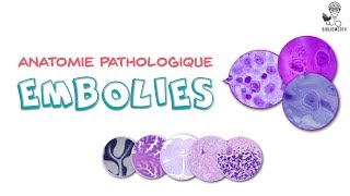 Anatomie Pathologique  les Embolies [upl. by Marven]