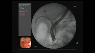 ERCP treatment Bile leakage after cholecystectomy [upl. by Lars257]