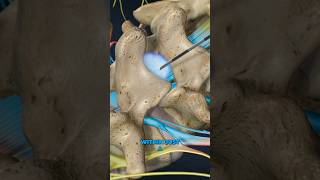 Lumbar Epidural Steroid Injection 3D Animation [upl. by Llemej]