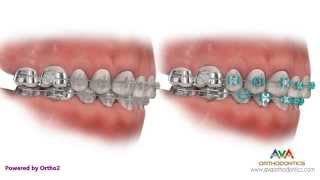 Different Types of Braces Metal Clear or Ceramic Hidden or Lingual [upl. by Laroy106]