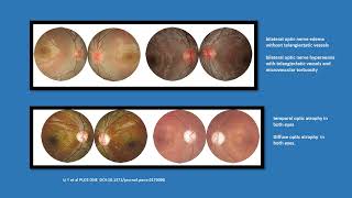 Neurology Quiz 98 Lebers hereditary optic neuropathy LHON [upl. by Eecrad]