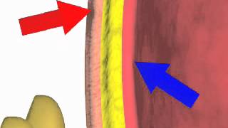 Paracentesis NEJM [upl. by Netsriik903]