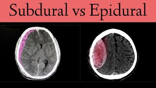 Subdural vs Epidural HematomaHemorrhage CT Scan Findings [upl. by Amikahs]