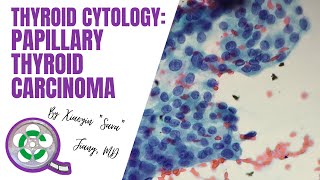 Thyroid Cytology Papillary Thyroid Carcinoma [upl. by Htenay]