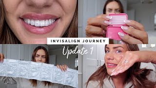 I GOT INVISALIGN WHY HOW LONG FOR ATTACHMENTS  INVISALIGN JOURNEY UPDATE 1 [upl. by Giacomo]