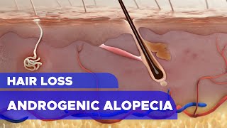 Hair Loss Androgenic Alopecia [upl. by Dajma]