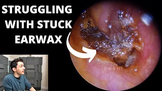 Struggling With Impacted Ear Wax Removal [upl. by Davin]